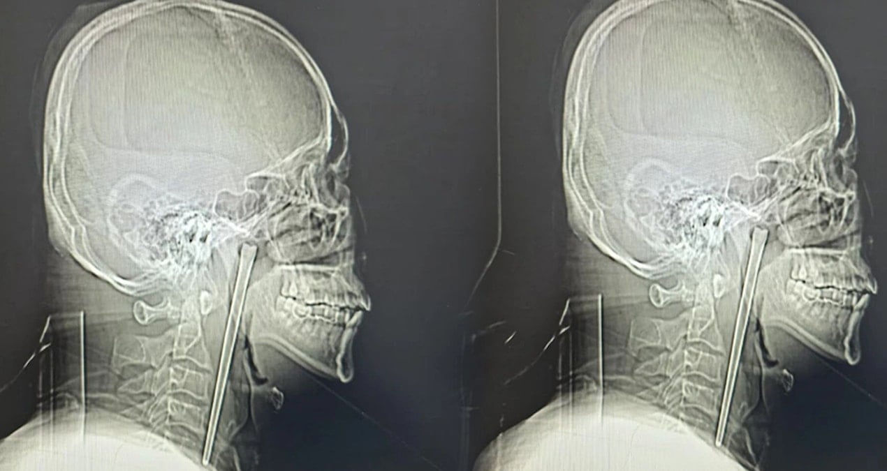 8 Yıl Boyunca Boğazındaki Metal Çubukla Yaşadı