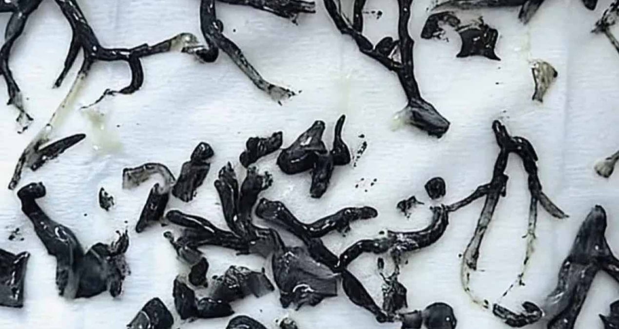 87 Yaşındaki Adamın Akciğerinden İnanılmaz Bir ‘Ağaç’ Çıkarıldı